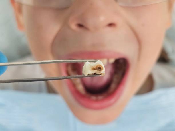 Best Emergency Dental Extractions in Belmont, CA