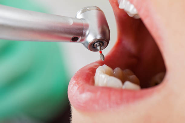 Best Emergency Dentist for Lost Fillings or Crowns in Belmont, CA